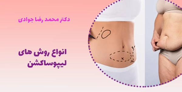 انواع روش های لیپوساکشن
