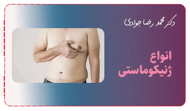 انواع ژنیکوماستی