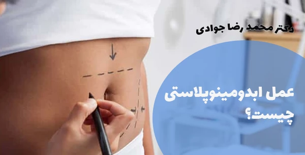 عمل ابدومینوپلاستی چیست؟