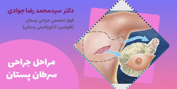 مراحل جراحی سرطان پستان
