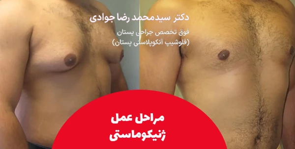 مراحل عمل ژنیکوماستی