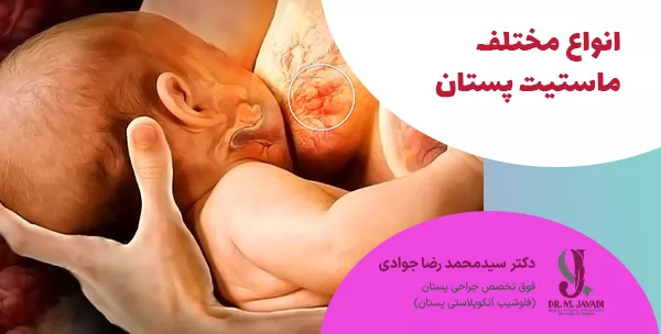 انواع مختلف ماستیت پستان