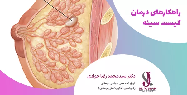 راهکارهای درمان کیست سینه