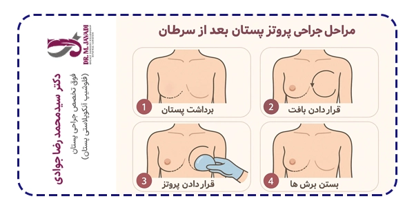 مراحل جراحی پروتز بعد سرطان