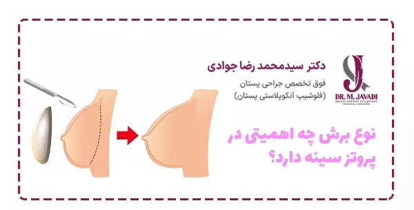 نوع برش چه اهمیتی در پروتز سینه دارد؟
