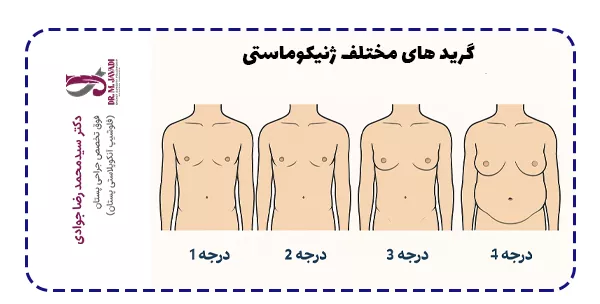گرید های مختلف ژنیکوماستی