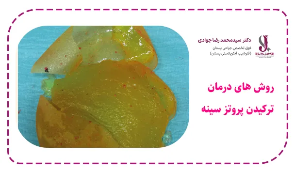 درمان پارگی پروتز سینه
