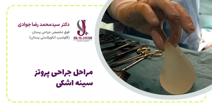 مراحل جراحی پروتز سینه اشکی