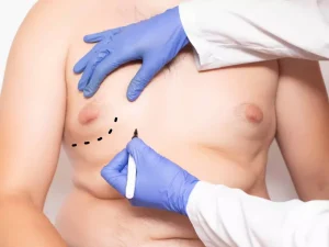 هزینه عمل ژنیکوماستی