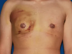 ورم بعد از عمل ژنیکوماستی