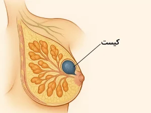 کیست پستان